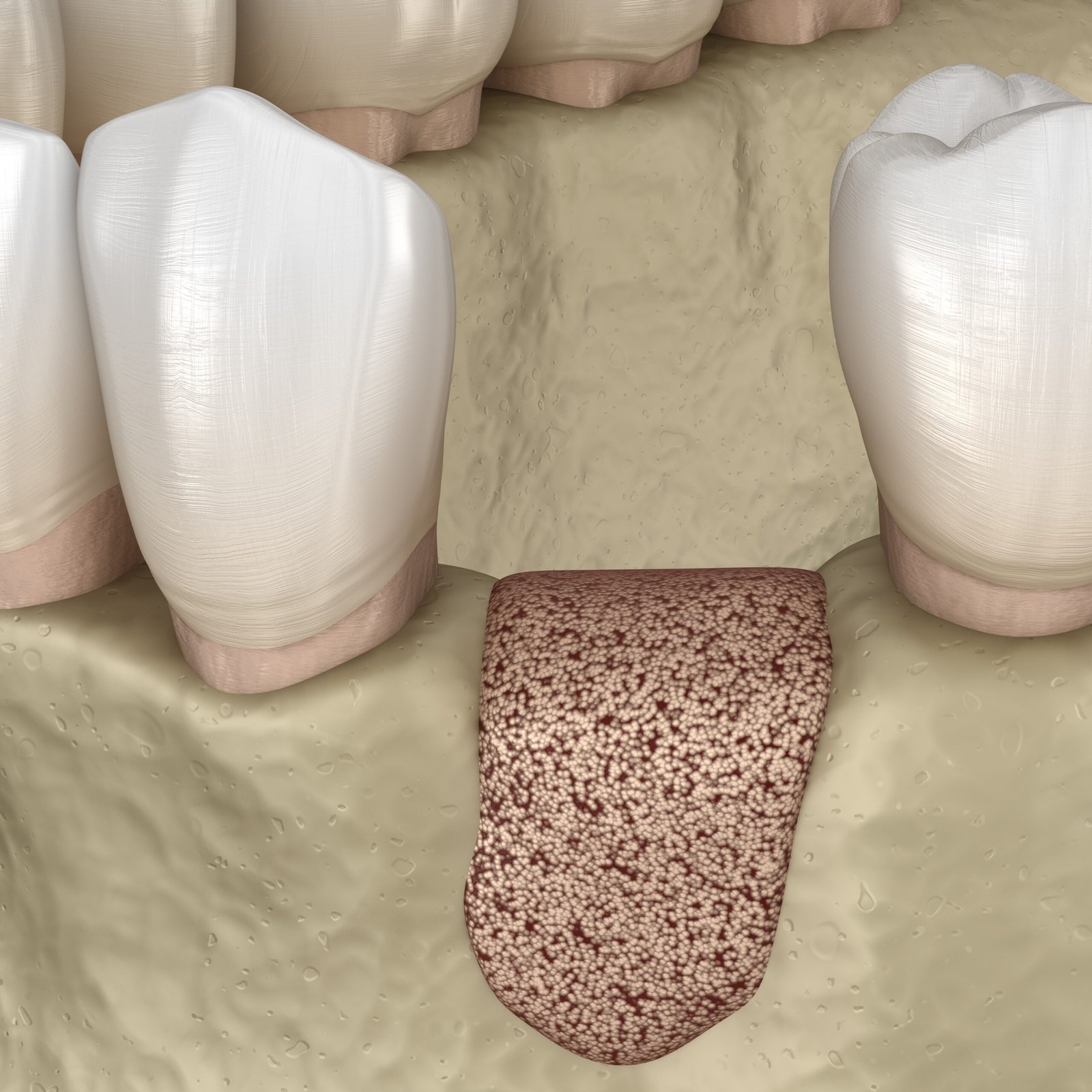 Knochenaufbau, Augmentation, Kieferchirurgie, Oralchirurgie Leipzig