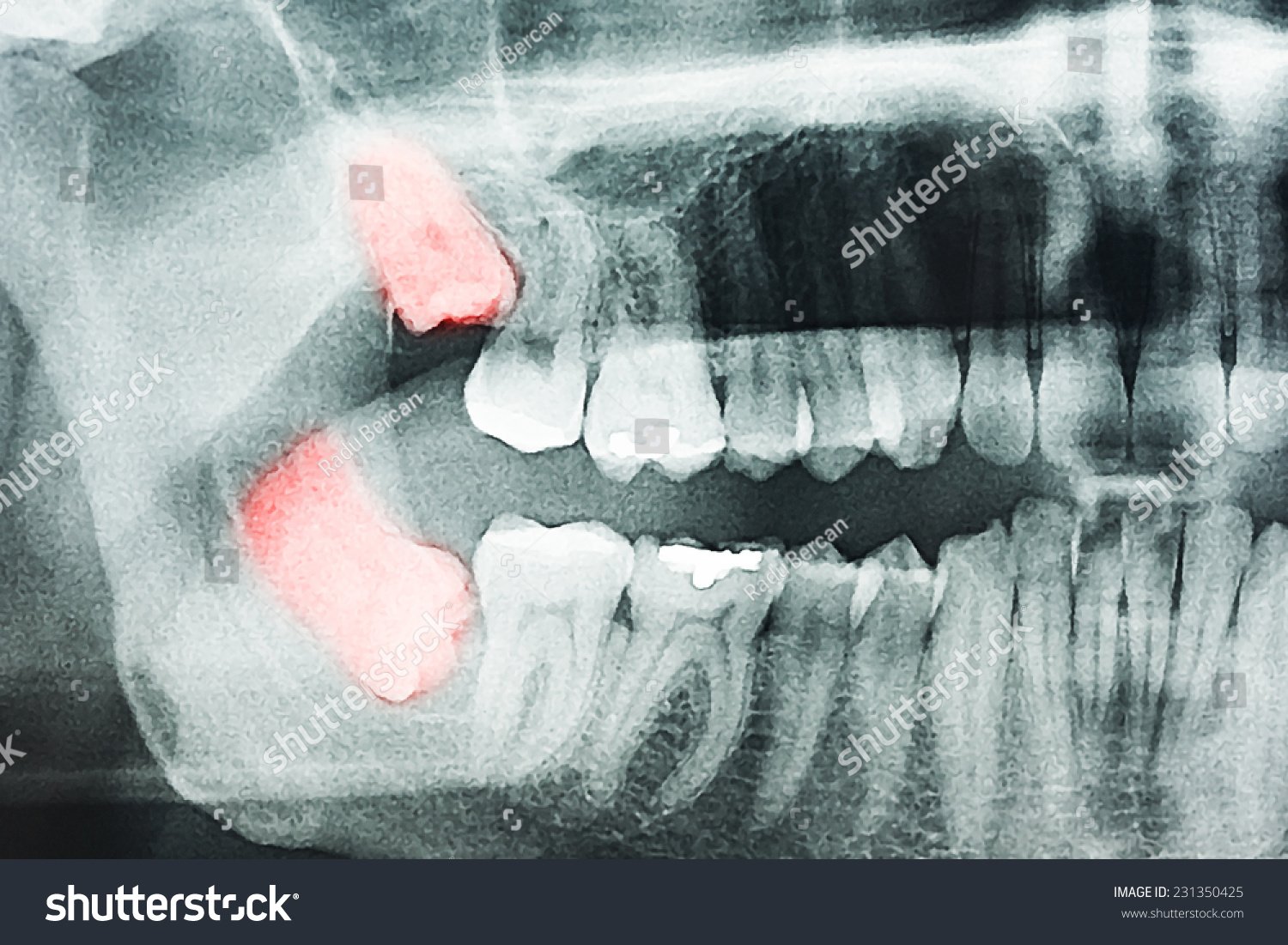 Oralchirurgie in Leipzig - Weisheitszahn