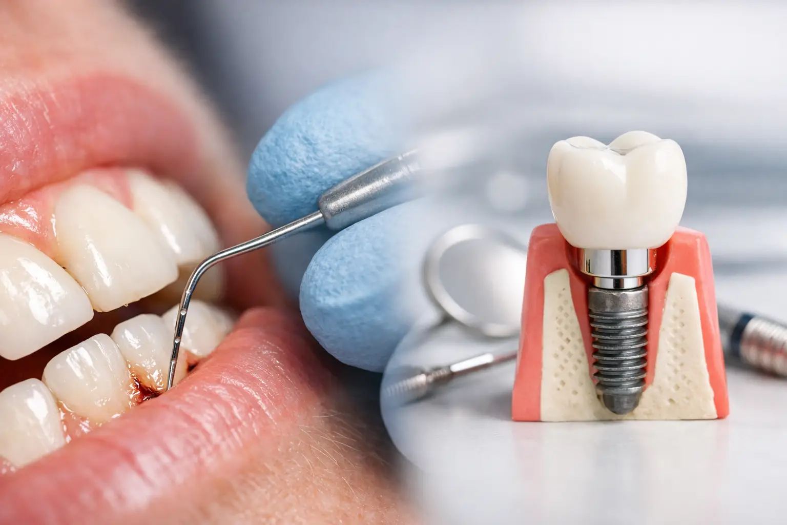 Parodontitis Behandlung vor Implantaten