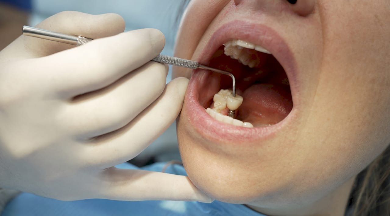 Der Zahnarzt passt das Provisorium direkt am frisch eingesetzten Implantat individuell an.