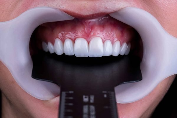 weisse Zaehne leipzig